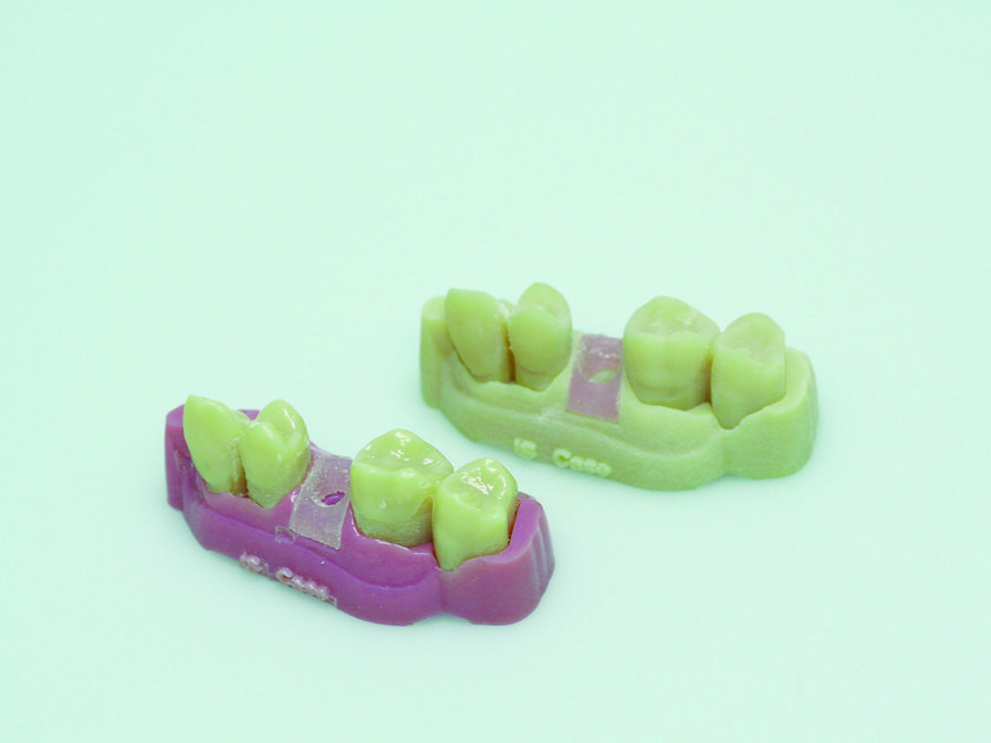 Dental model of molars with prosthetic guide