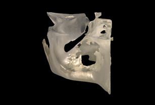 Patient-specific 3D printed models enable preparation of hybrid titanium mesh implants prior to surgery, reducing operating time.