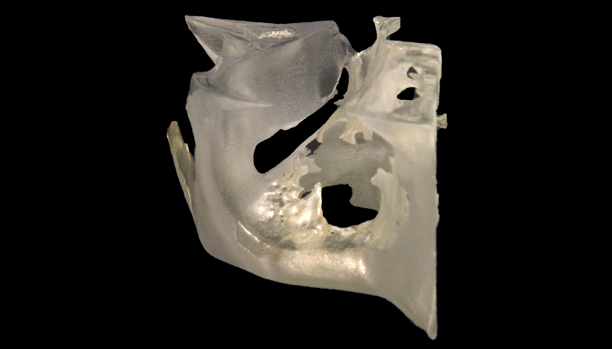 Patient-specific 3D printed models enable preparation of hybrid titanium mesh implants prior to surgery, reducing operating time.