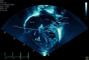 3D Printed Heart Model Helps Cardinal Glennon Children’s Hospital Plan Complex Surgeries