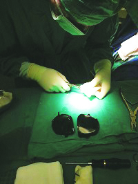 Surgeon trimming bone cement after successful removal from a 3D printed mold.