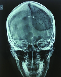 A 23-year old woman’s successful cranioplasty using 3D printing technology.