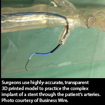 stent