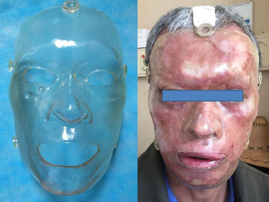 A 3D printed mask (left) and shown fitted on the patient (right).1&nbsp;
