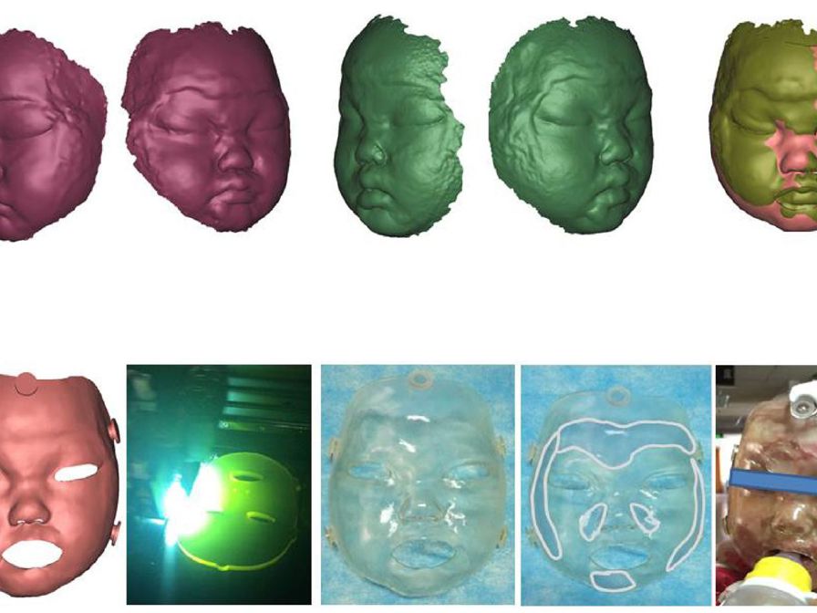 This image shows the process of developing a 3D printed infant mask, starting with facial scans in the upper left culminating in the
3D printed mask creation (bottom row).2