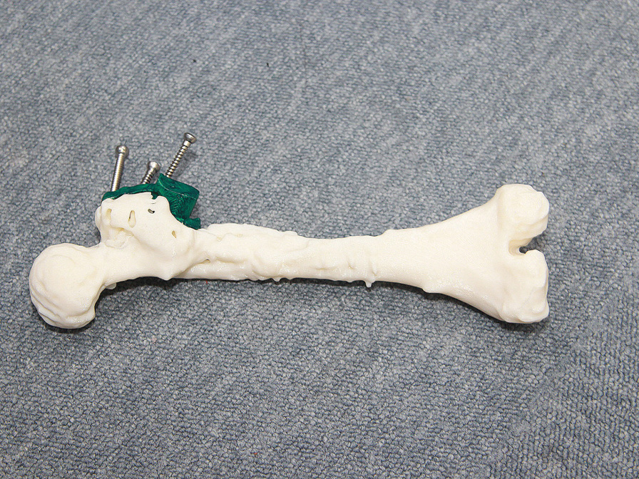 Surgeon's pre-surgery planning uses 3D models increases accuracy during the actual surgery. One of the most common incision sites in bone cancer surgeries is at the end of the femur, close to the knee joint.