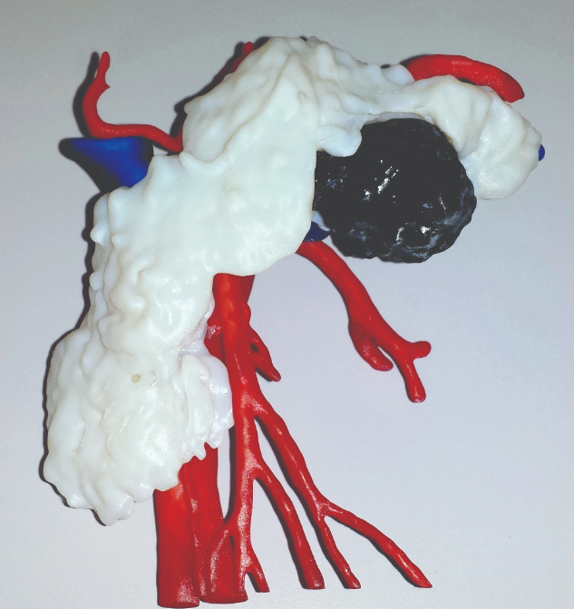 3D printed anatomical models help reduce unexpected
risks during surgery.