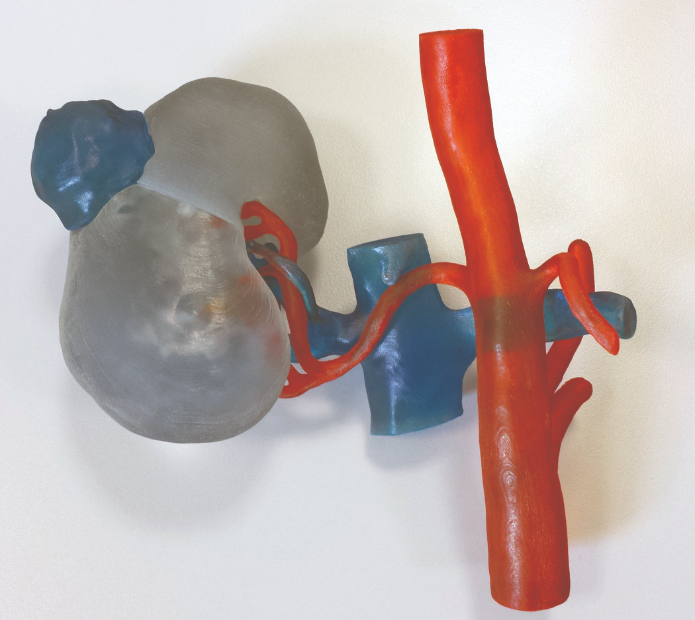 3D printed kidney model in VeroClear demonstrates the
small details of the complex vascular system