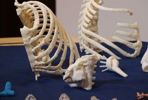 3D printed models of the thoracic wall enable surgeons to plan, perform and perfect the resection on the 3D model ahead of the actual surgery.