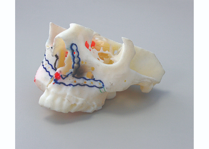 The in-house Stratasys 3D printer enables the creation ofexact replicas of the patient’s anatomy.