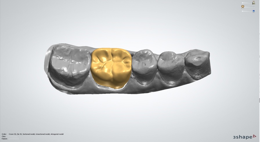 3d printing dental implants