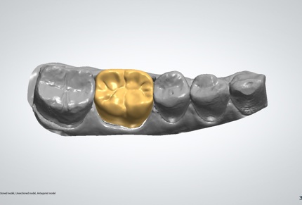 3d printing dental implants