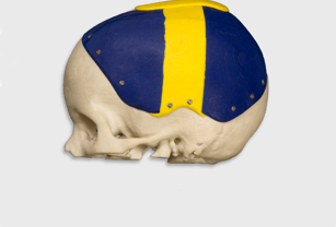 Renato Archer’s Information Technology Center helped create cranial prostheses for a 12-year-old car accident victim. The center designed a skull to adjust to the child’s growth, year after year.