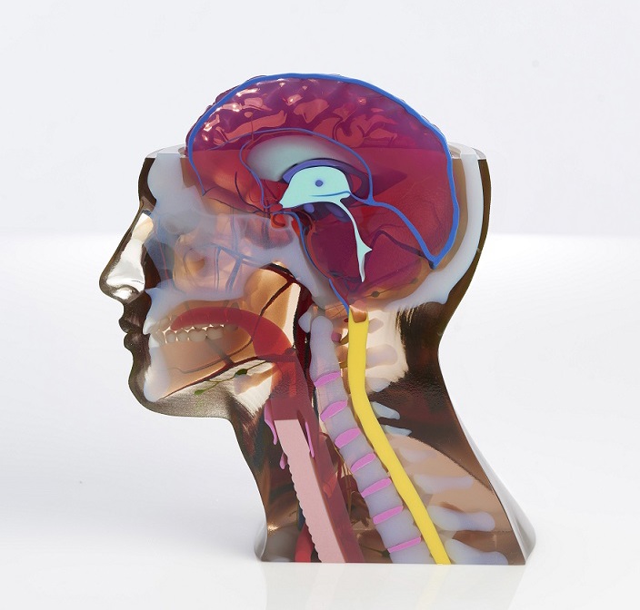 3D printed medical spine splint mounted on a child