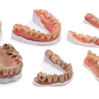 Dentures 3D printed with Statasys VeroVivid material