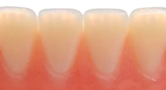 truedent-lower-incisal
