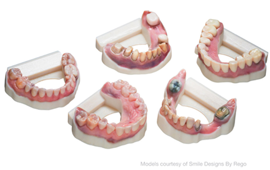 Why print dental models in color?
