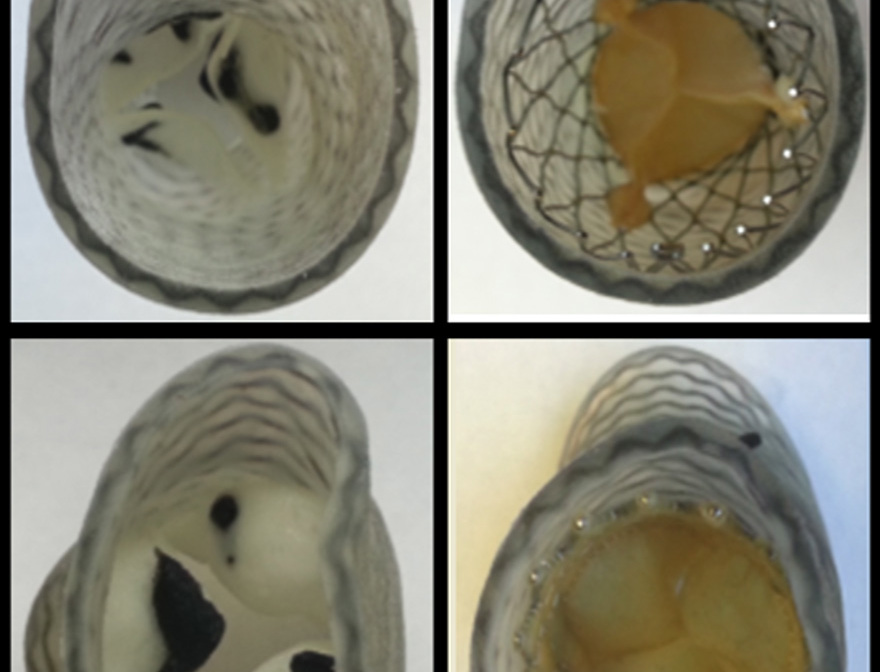 3D printed heart valves assist cardiologists in planning patient specific replacement surgeries.