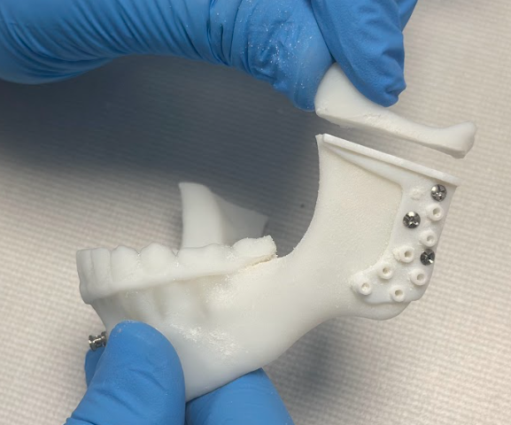 galilee medical 3d printed jawbone guide