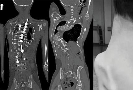 3D Printing Supports Treatment for Dorsal Scoliosis